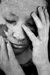 敏感肌の人がワキガ手術後に気を付けるべき色素沈着の予防法は？
